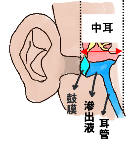 滲出性中耳炎(しんしゅつせいちゅうじえん)とは